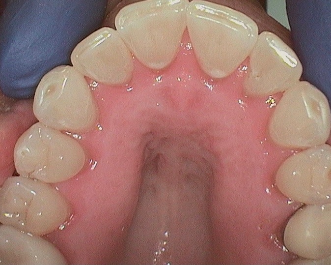after of upper teeth straightening
